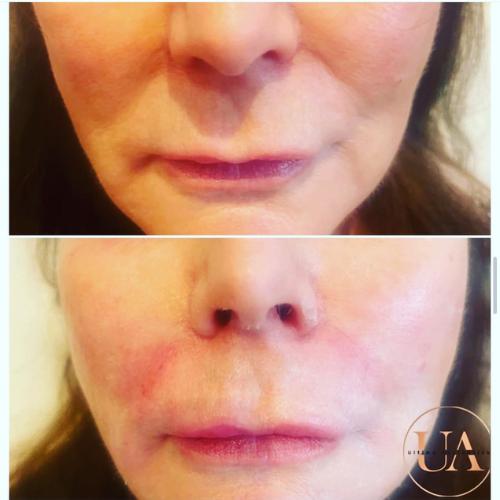 Nasolabial filler