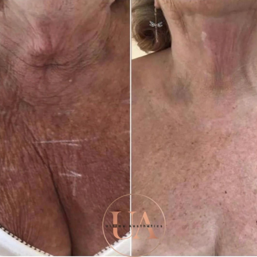 Skin Boosters Décolletage Before and After Treatment