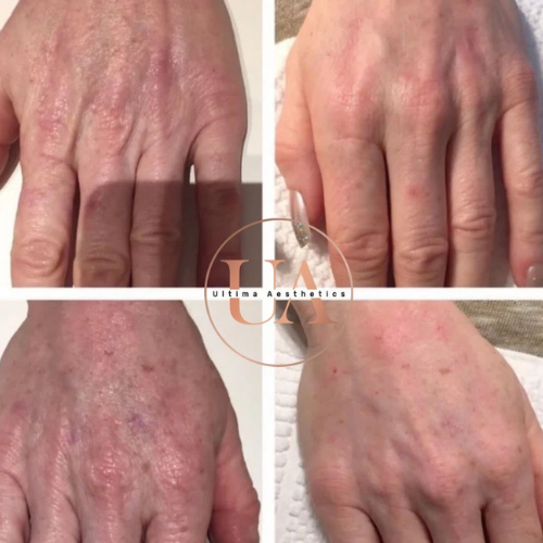 Back of Hands Skin Boosters Before and After Treatment