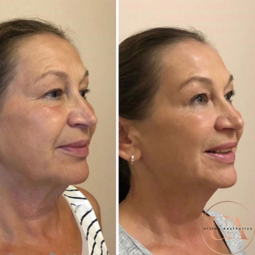 Skin Boosters Essex