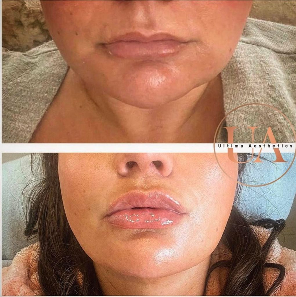Natural lips filler injection