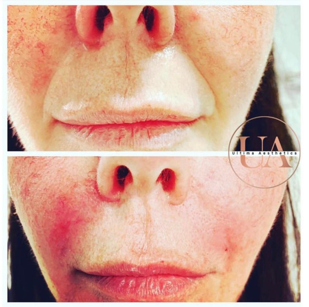 Nose To Mouth Line Filler