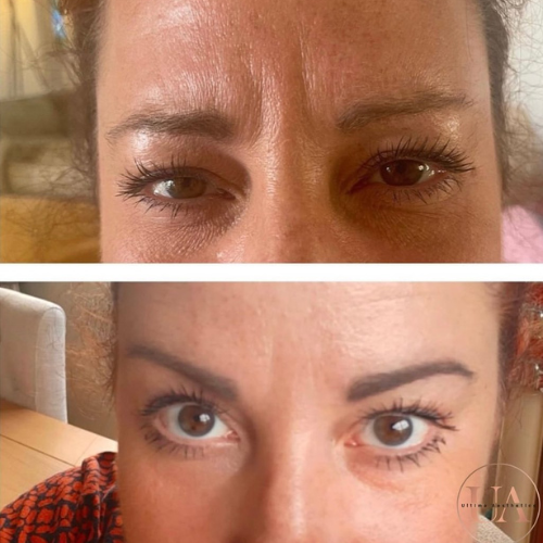 Botox anti-wrinkle to frown