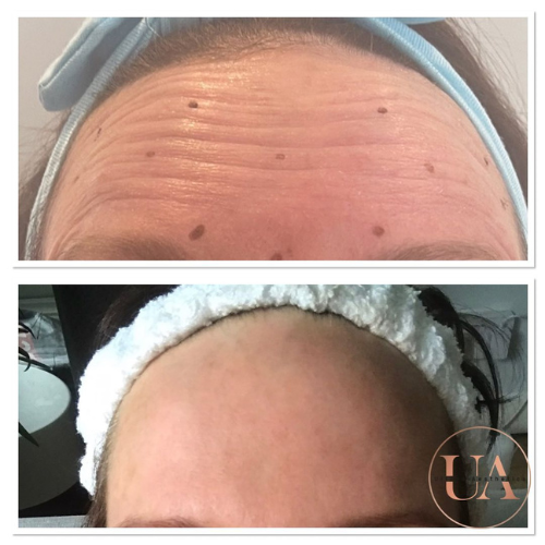 Forehead anti-wrinkle Botox