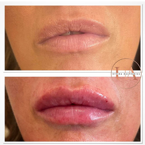 Lip volume filler injection
