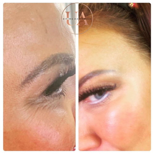 Botox anti-wrinkle for crows feet