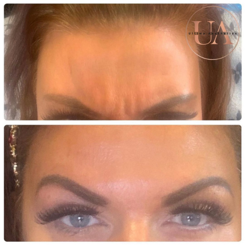Botox anti-wrinkle to forehead