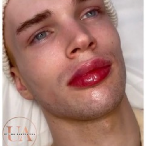 Volume plump juicy lips filler