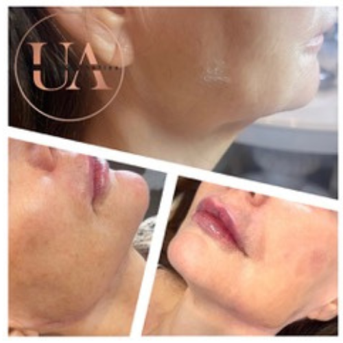 Jawline filler