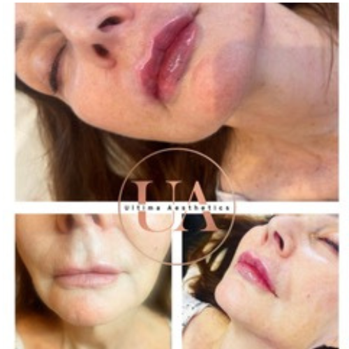 Natural lips filler