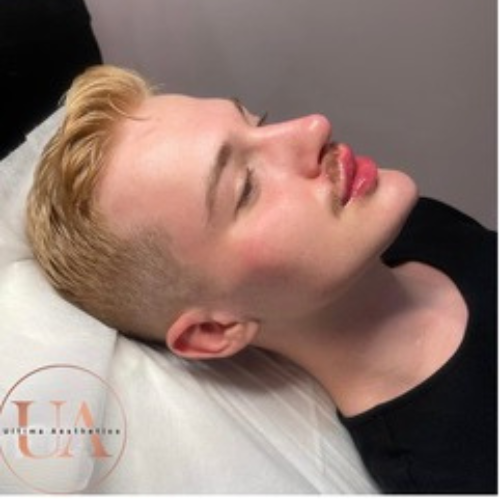 Cheeks jaw chin lips filler