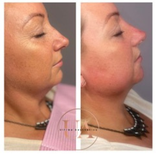 Non surgical rhinoplasty & pixie tip lift filler