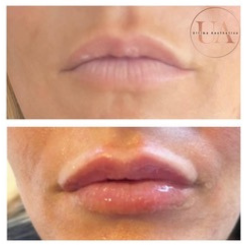 Natural lip filler