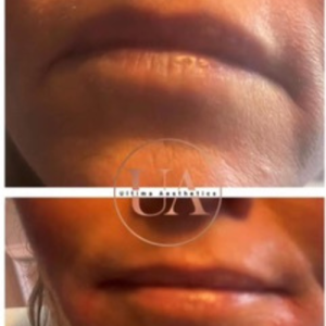 Marionette Lines Billericay Before and After Treatment