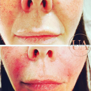 Nose To Mouth Lines Before and After Treatment