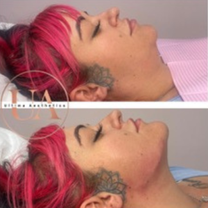 Jawline Filler Billericay Before and After Treatment