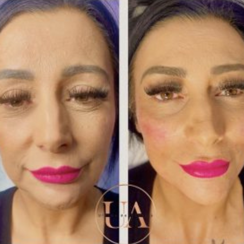 Cheeks & Jawline filler