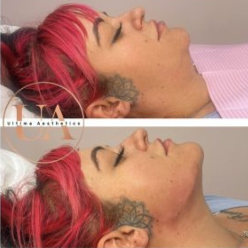 Jawline filler