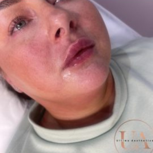 Russian lip filler