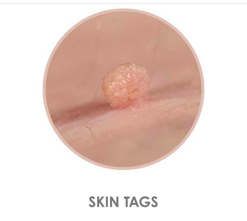 Skin Tags On Facial Skin