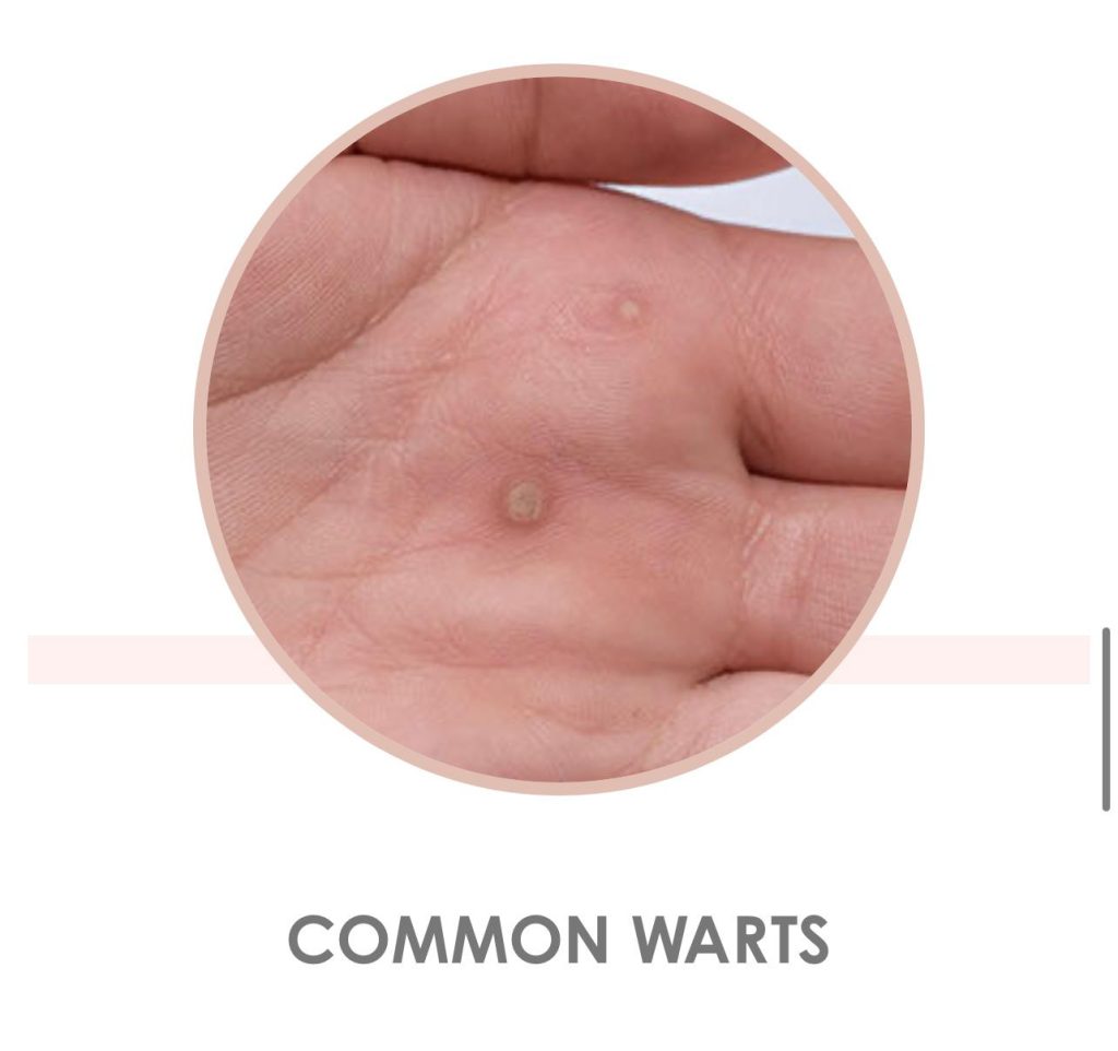 Common warts on hands | Skin problem image