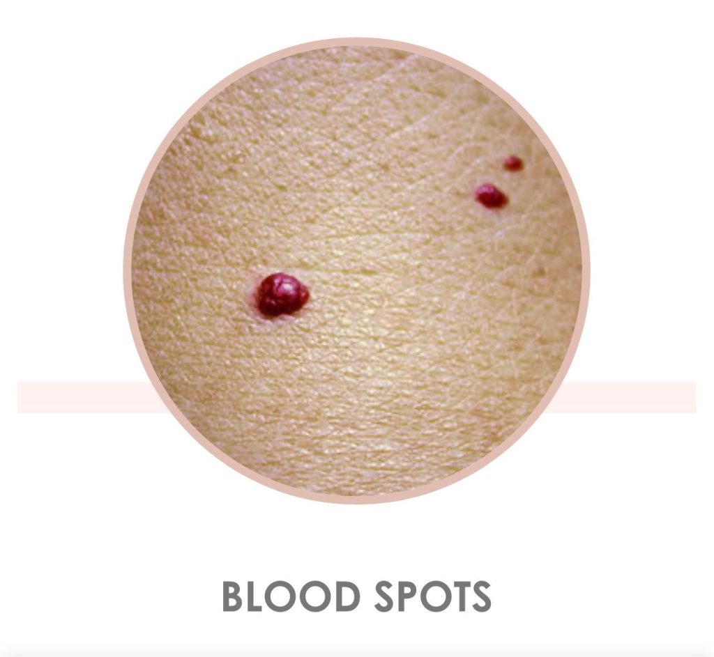 Blood spots on the skin