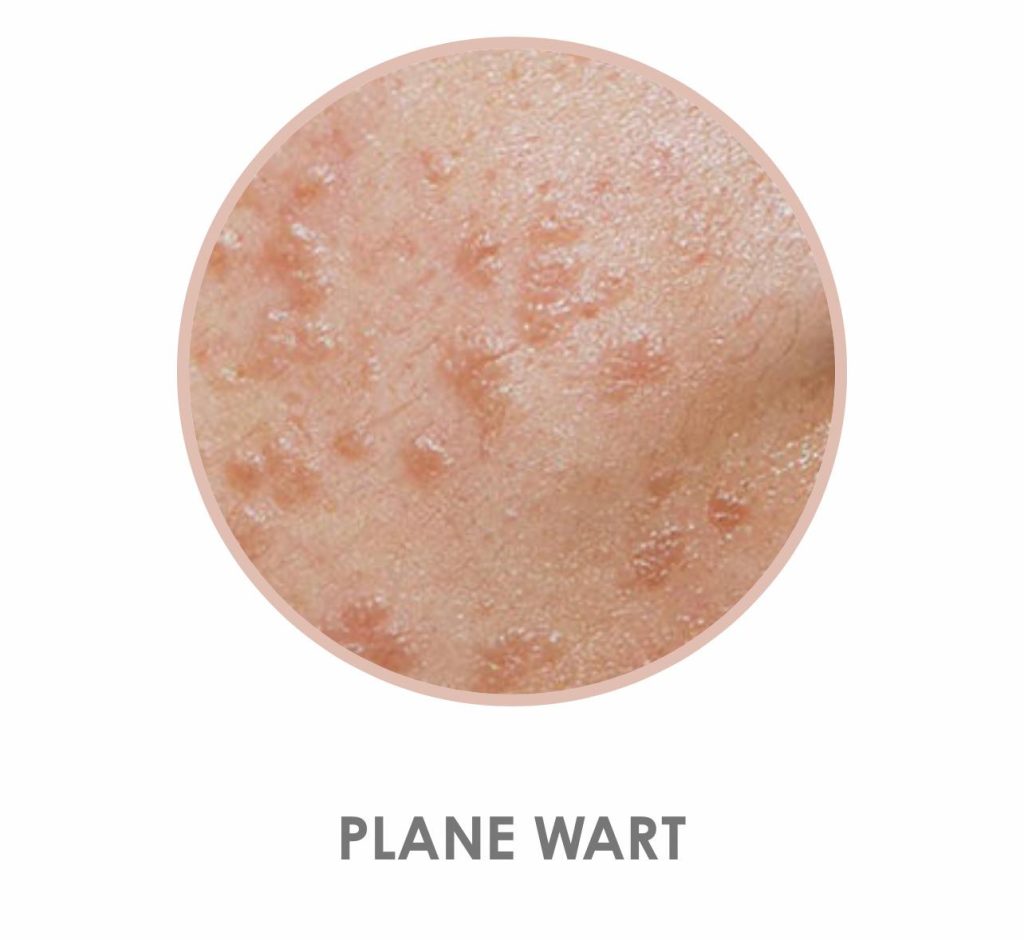 Plane Wart Skin Problem Image