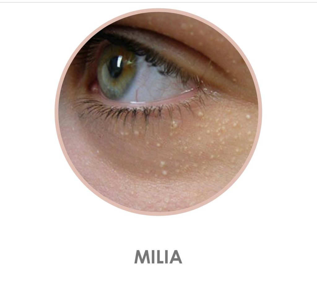 Milia on the eyes