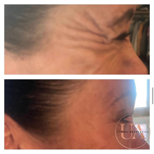 Anti Wrinkle Injections Billericay