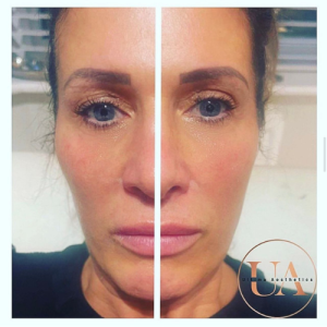 Dermal Fillers Billericay